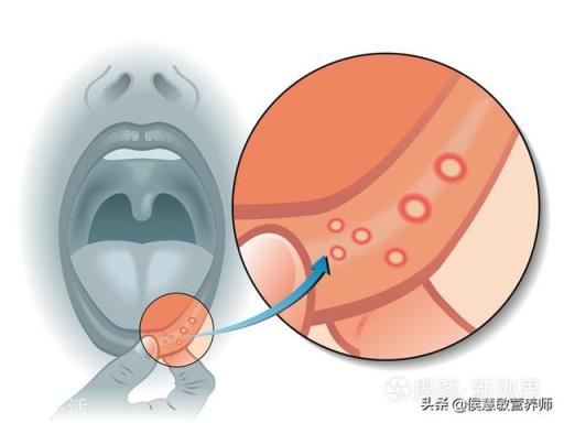 可加速口腔溃疡愈合的到底是维生素B2还是维生素B12？