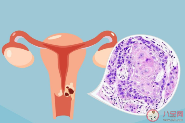 从HPV感染到宫颈癌到底会经历什么 怎么预防hpv感染避免宫颈癌