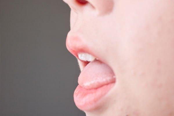 怎么预防口腔溃疡 形成口腔溃疡的原因