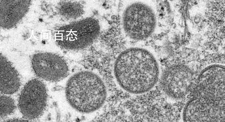 美国发现首例孕妇猴痘病例 新生儿被注射了免疫球蛋白已安全出生