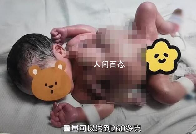 深圳一男婴出生时四手四脚 寄生胎是怎么形成的